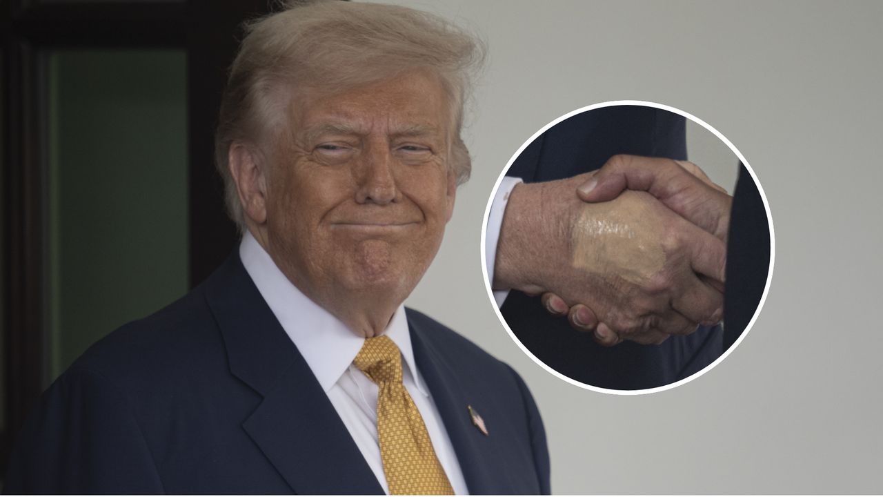 Zdjęcie dłoni Donalda Trumpa zaniepokoiło internautów. Biały Dom zareagował