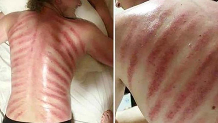 Zdecydował się na masaż, był w szoku, gdy rano zobaczył swoje plecy