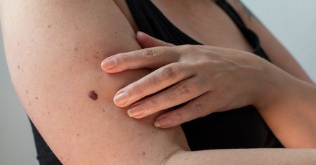 Widzisz wokół pieprzyka? Tak wygląda rak