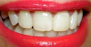 Zęby białe jak śnieg