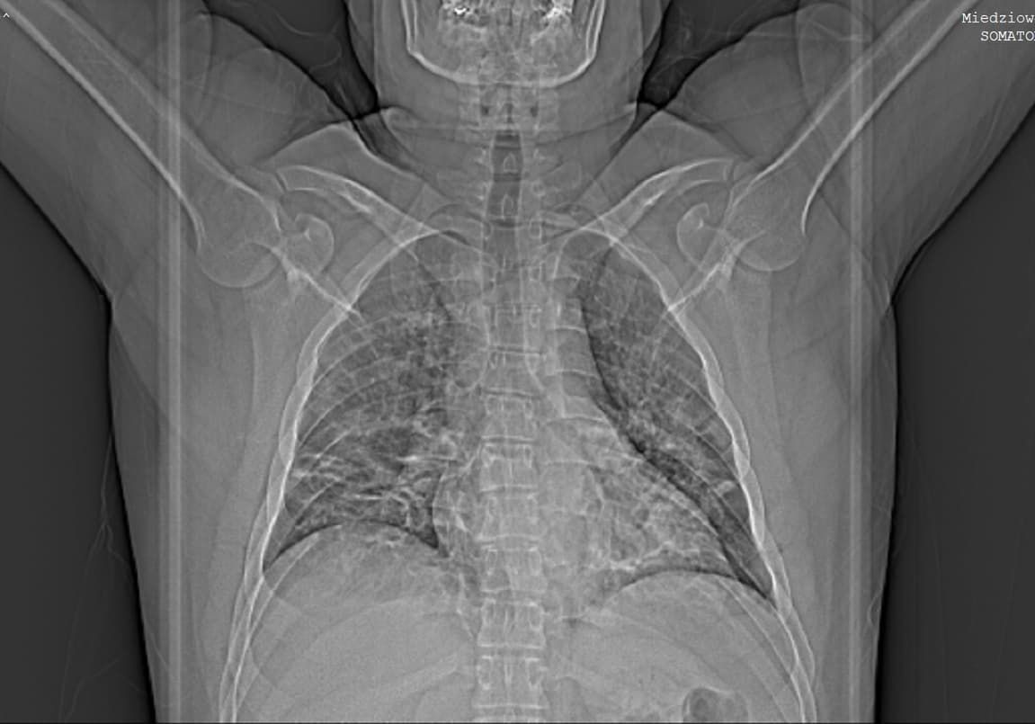 Podczas zapalenia śródmiąższowego płuc dochodzi do wysięku w pęcherzykach płucnych