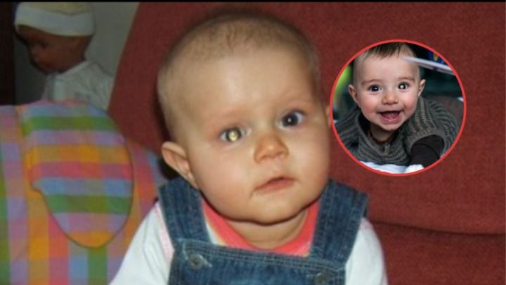 Nowotwór oka u dziecka. Ten objaw widać na zdjęciach