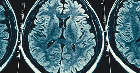 Zdiagnozowano u niego chorobę Alzheimera. Ma zaledwie 19 lat