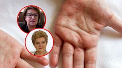 Polacy walczą z superbakteriami. "Mamy wysyp dwóch chorób"