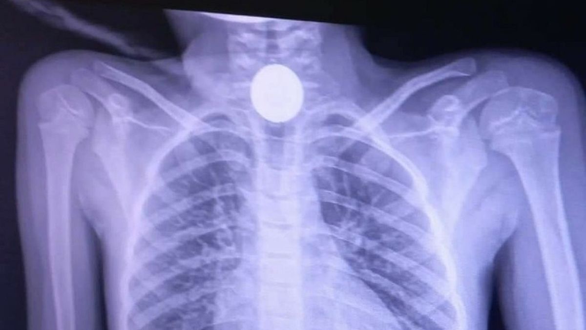 Zdjęcie rentgenowskie 6-letniej dziewczynki