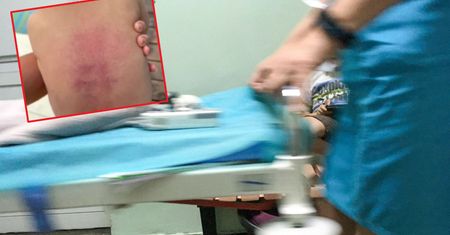 Ratowniczka pokazała posiniaczone plecy dziecka. Rodzice boją się, że skrzywdzą malucha