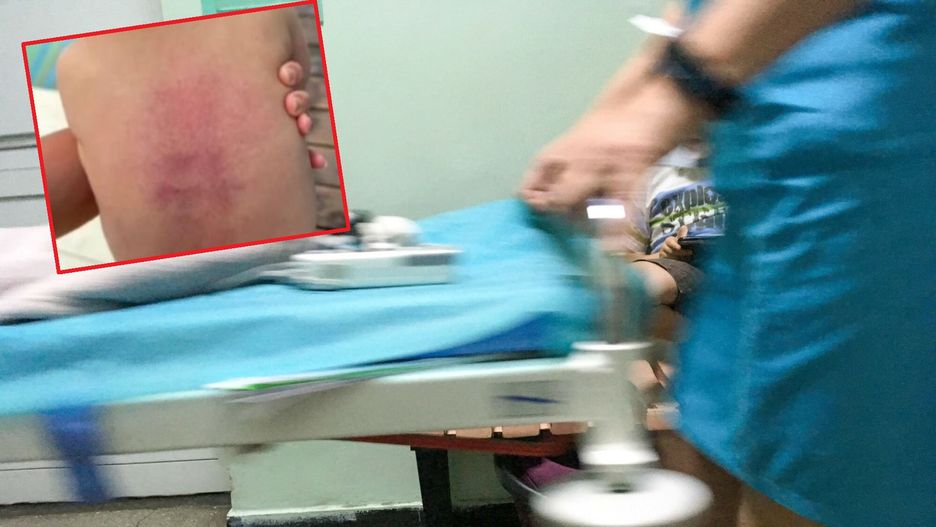 Pierwsza pomoc w przypadku zakrztuszenia i zadławienia