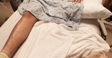 Pojawia się po COVID-19 i powoduje martwicę tkanek. Narażone 3 grupy
