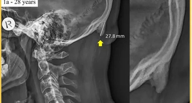 Korzystanie ze smartfonów może powodować zmiany anatomiczne. Naukowcy prezentują dowody