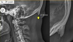 Korzystanie ze smartfonów może powodować zmiany anatomiczne. Naukowcy prezentują dowody