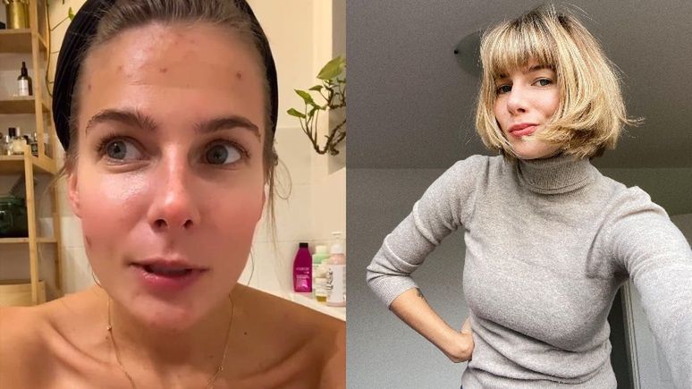 Marta Wierzbicka walczy z trądzikiem
