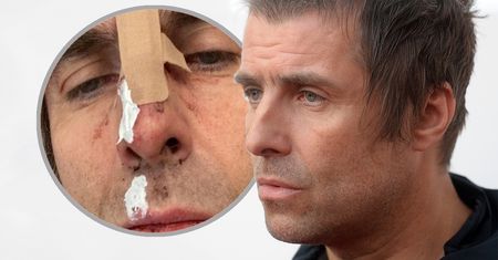 Liam Gallagher wypadł z helikoptera? Pokazał obrażenia