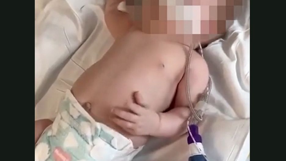 Tak wyglądają objawy zakażenia RSV u niemowląt. Wirus zabija 50 tysięcy dzieci rocznie