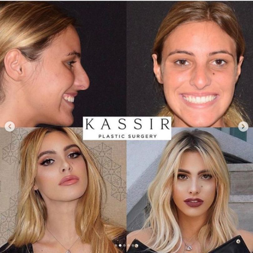 Chirurg plastyczny zaprezentował metamorfozę Lele Pons
