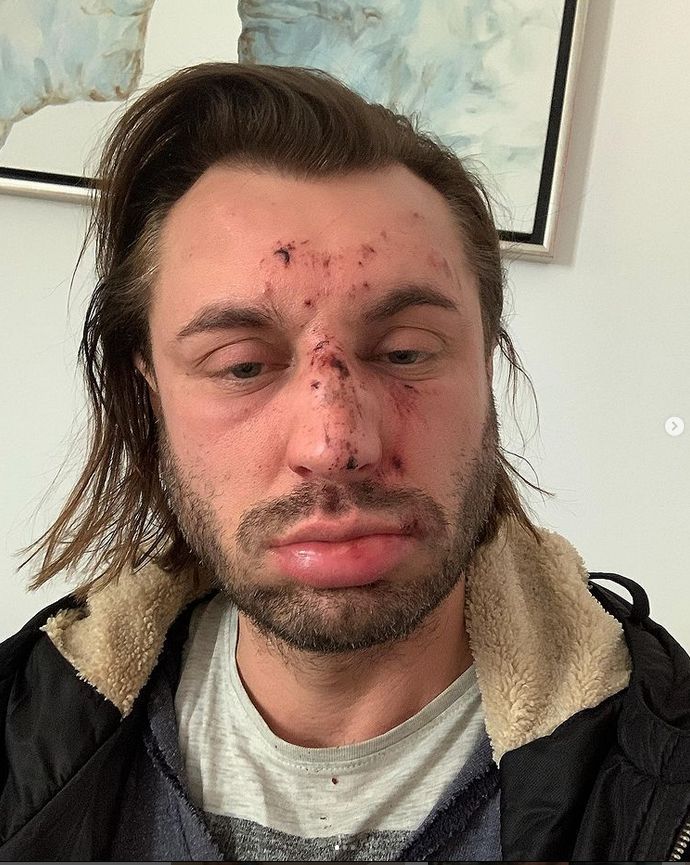 Rafał Grabias został pobity i okradziony