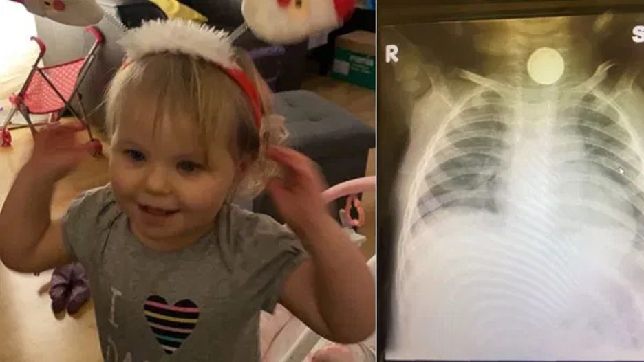 Sofia połknęła baterię. Potrzebna była interwencja chirurga