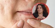 Wyciskasz pryszcze? Dermatolożka bije na alarm