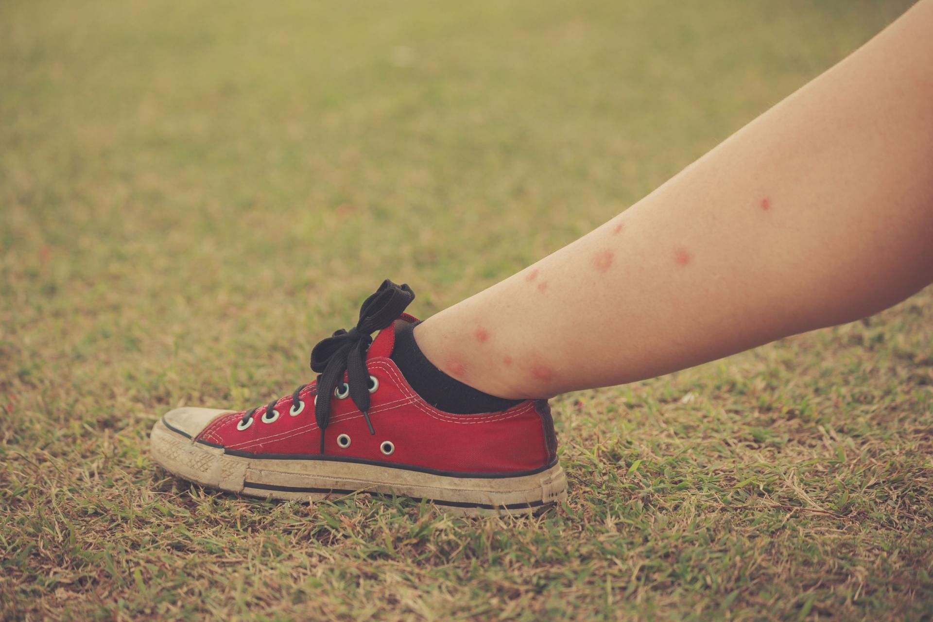 ugryzienia meszek [123rf.com]