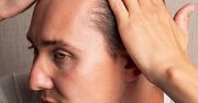 Wypadanie włosów. Dlaczego to spotyka coraz młodszych mężczyzn?