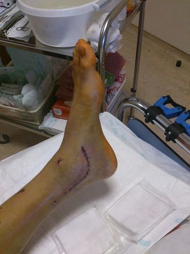 Noga Andrzeja Wawrzyka po operacji / fot. Facebook