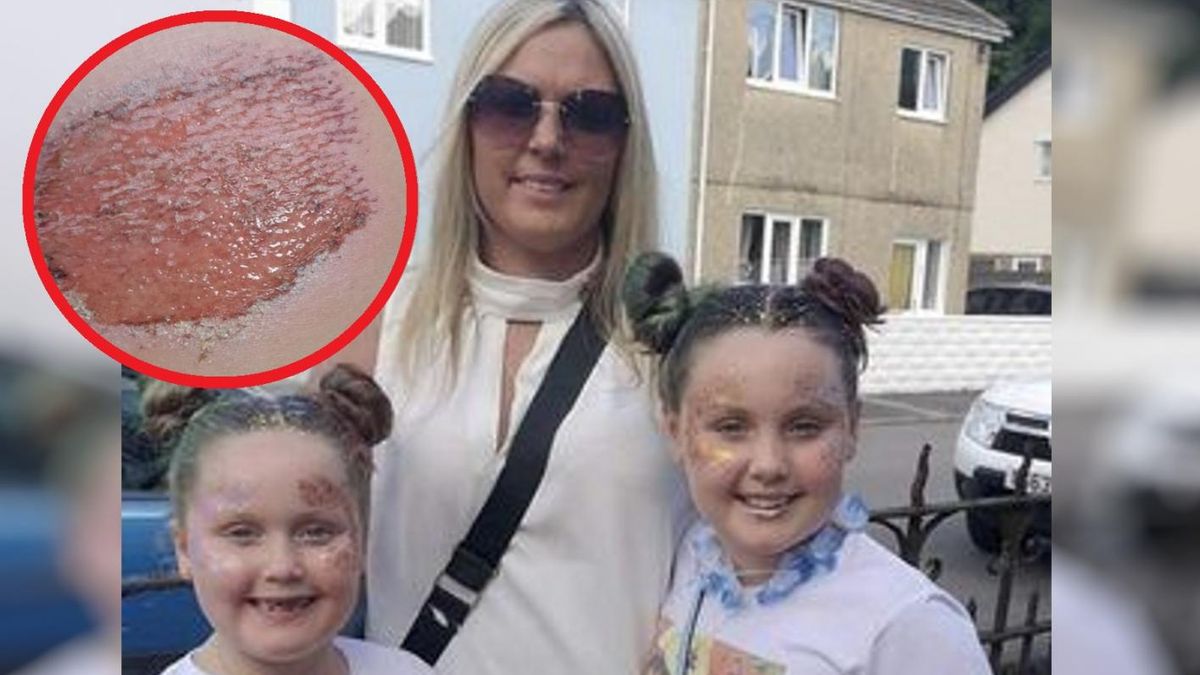 Zabawa skończyła się poparzeniem nogi