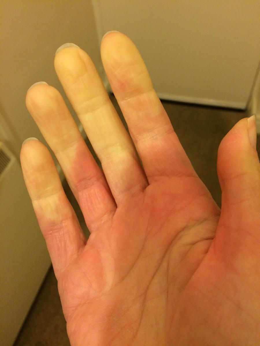 Objaw Raynauda