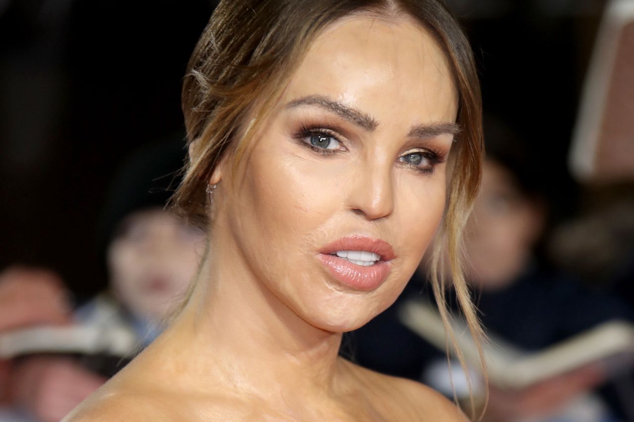 Katie Piper przeszła kolejną operację. Oblana kwasem Brytyjka pokazała zdjęcie ze szpitala