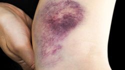 Krwiak - przyczyny, objawy, leczenie