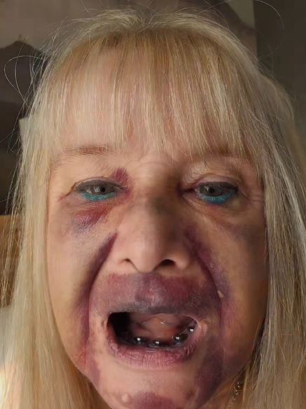 Brytyjka zrobiła sobie tureckie zęby