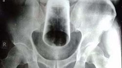 Skarżył się na zaparcia. To lekarze odkryli w jego odbycie