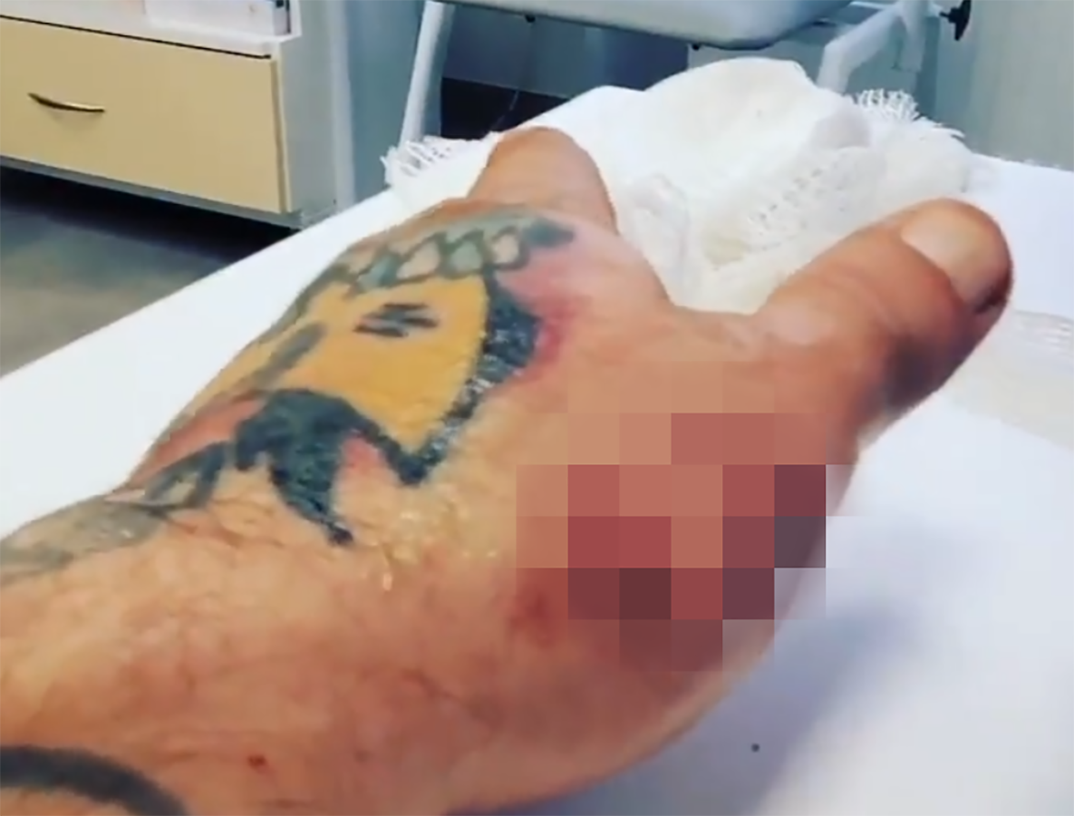 Popek pokazał dziury w ręce po wyciągnięciu z niej metalowych sworzni