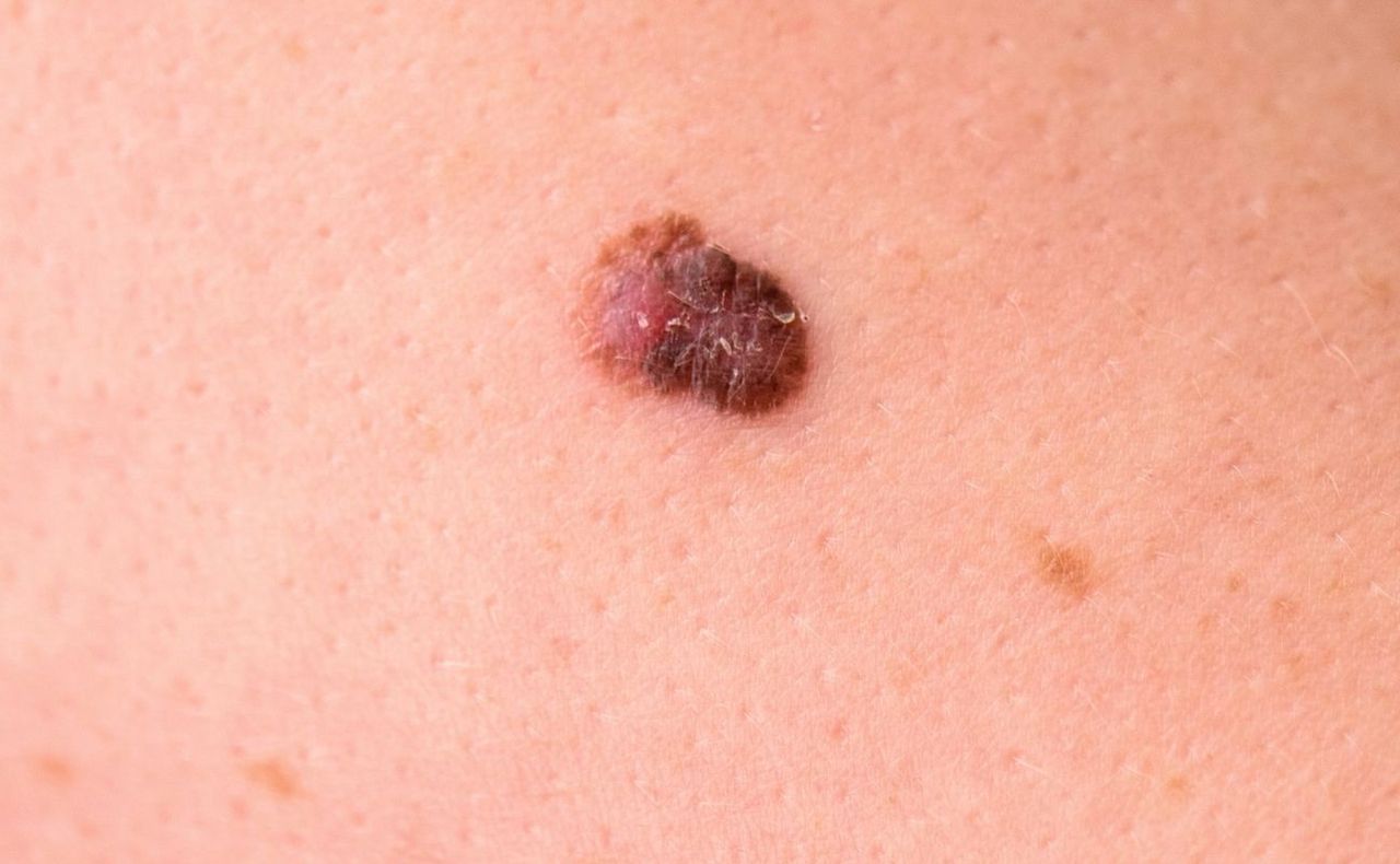 This mole was diagnosed as skin cancer.