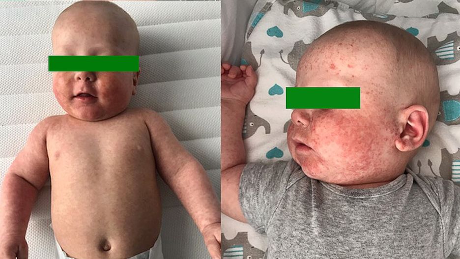 Pięciomiesięczne dziecko chorujące na odrę. 