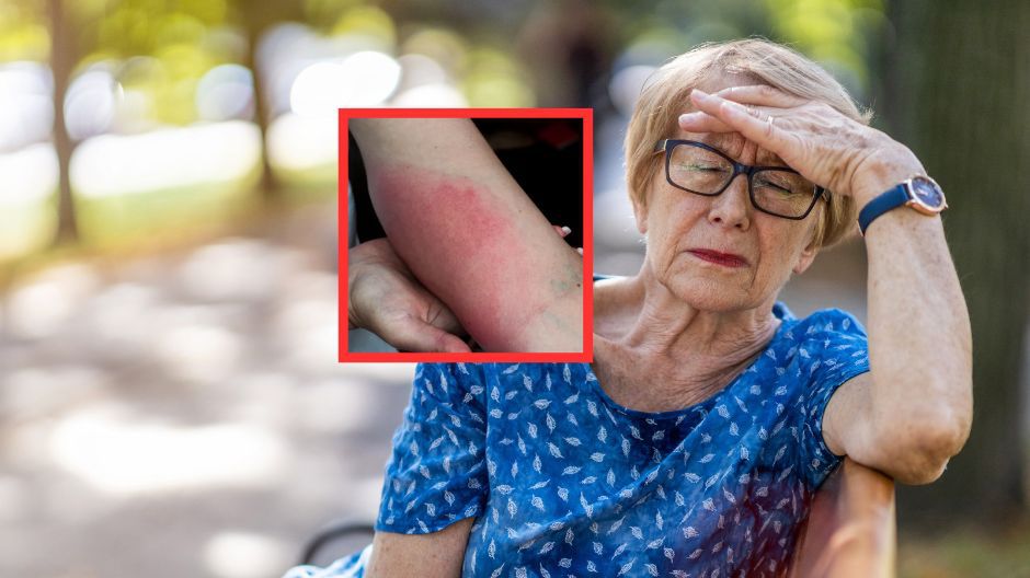 Trzy tysiące przypadków więcej. W Polsce szaleje borelioza