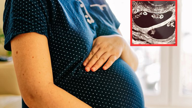 Lekarze nie mogli uwierzyć. Taka ciąża to rzadkość