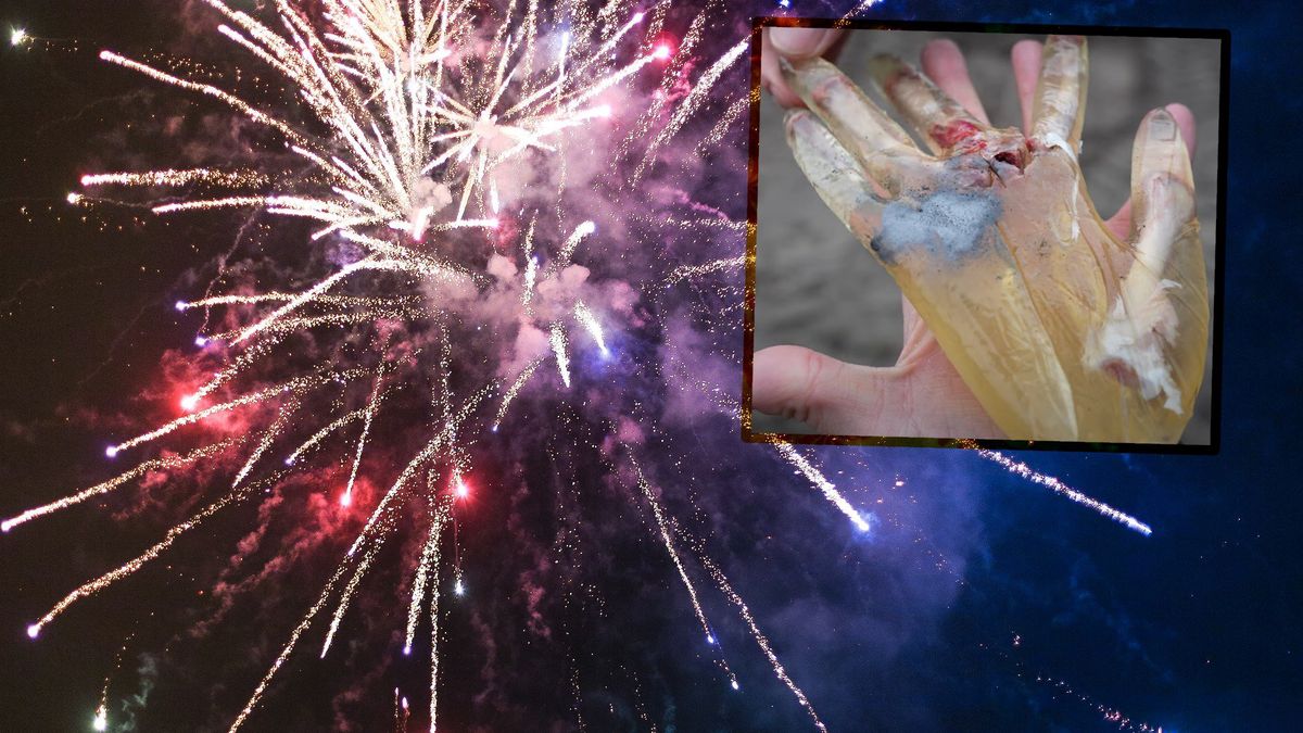 Petardy i ręka dziecka. Tak się skończyło