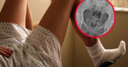 Nosiła spiralę przez 20 lat. Omal nie skończyło się tragedią