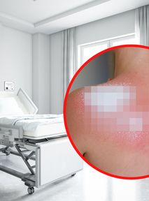 Poparzyła dziewczynkę kwasem. 12-latka z zarzutami