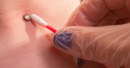 O tym robi się głośno. Microdermal, czyli nowoczesna metoda piercingu