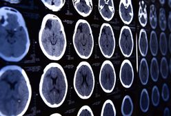 Wielka Brytania: 20-latek otrzymał druzgocącą diagnozę. "Czułem najgorszy ból głowy"