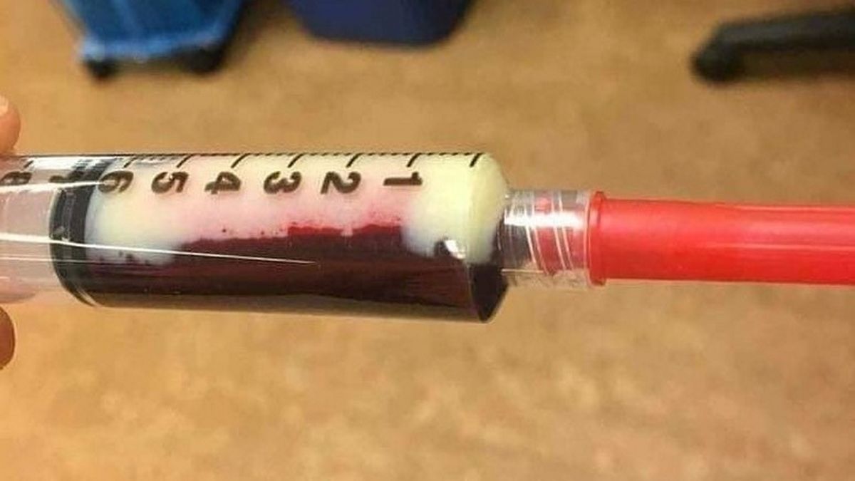 Ratownicy medyczni udostępnili w mediach społecznościowych wymowne zdjęcia z badania stężenia trójglicerydów we krwi. 