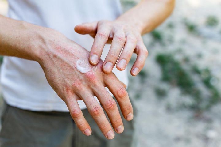 Suche dłonie nie tylko wyglądają nieestetycznie, ale często także swędzą i pieką. Ten dyskomfort jest najczęściej objawem nieodpowiedniej pielęgnacji rąk.