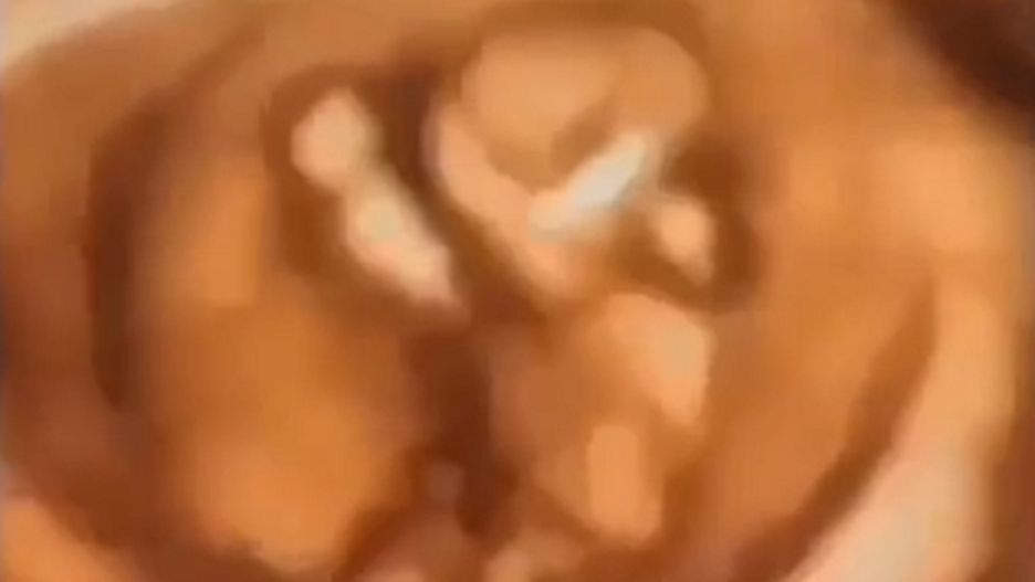 Zabawne nagranie z USG. Dziecko tańczy w łonie matki