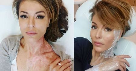 Oblana kwasem ofiara stalkera z dumą prezentuje blizny: "W procesie leczenia docenia się swoją wartość" (FOTO)