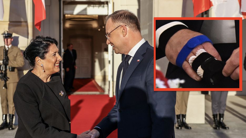 Uraz ręprezydenta nie umknął uwagi dziennikarzy i fotoreporterów