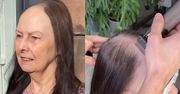 Choruje na łysienie plackowate. Jedna wizyta u fryzjera odmieniła jej wygląd