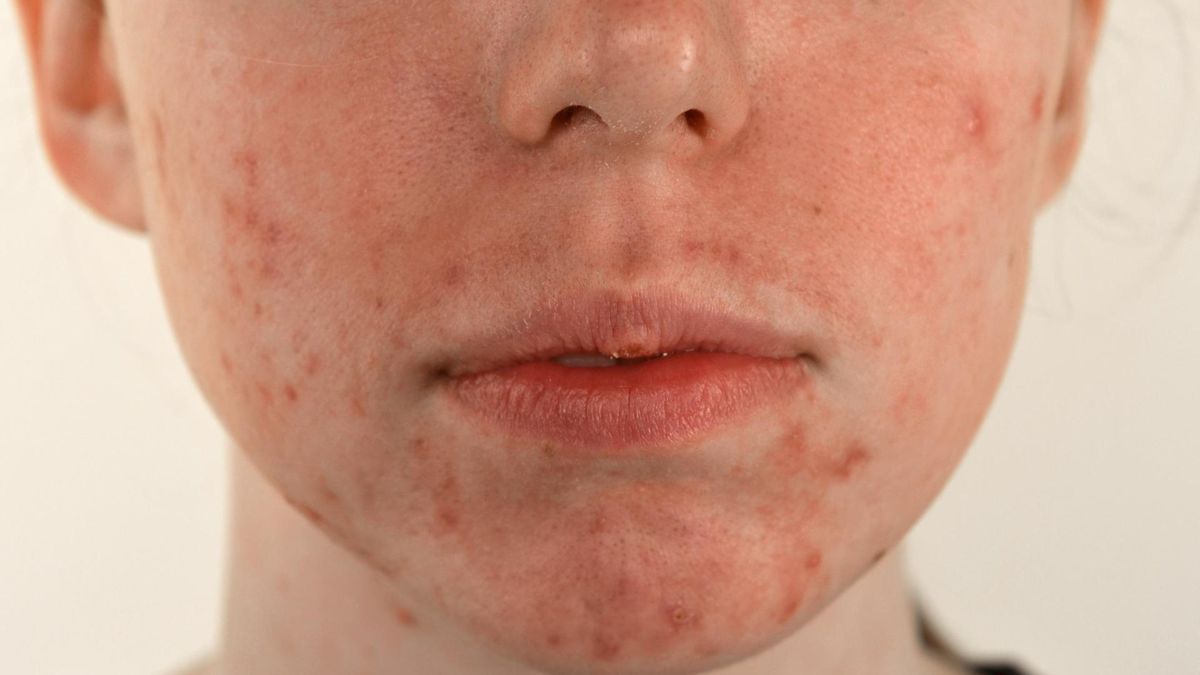 Jak bezpiecznie stosować kwasy w domu?