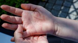 Choruje co piąty Polak. Objawy często pojawiają się na skórze