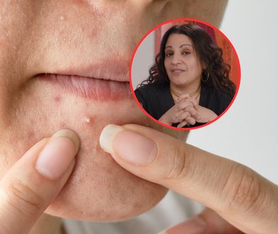 Wyciskasz pryszcze? Dermatolożka bije na alarm