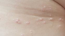 Mięczak zakaźny - jak leczyć u dzieci i u dorosłych?